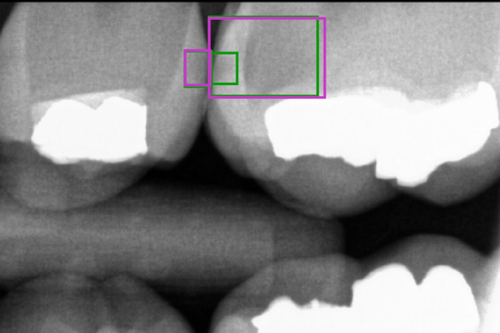Čeští vědci našli způsob, jak s pomocí umělé inteligence spolehlivěji odhalit zubní kazy
